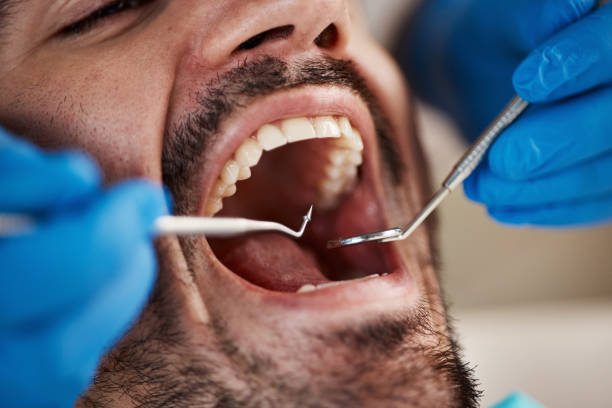 Best Emergency Tooth Extraction in Medina, TX