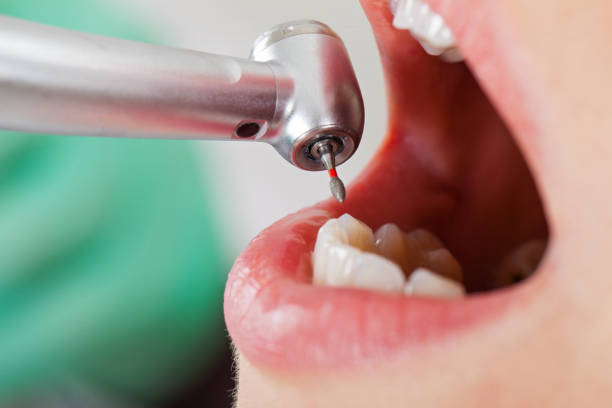 Best Emergency Wisdom Teeth Removal in Medina, TX